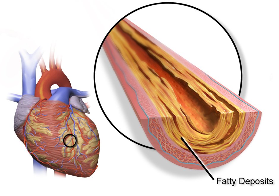 CRMjournal's tweet image. #Evaluation of #lesion #flowcoefficient for the detection of #CoronaryArteryDisease in #patientgroups from two #academicmedicalcenters by Srikara V. Peelukhana et al. in April/May issue: bit.ly/2Ke2sCQ