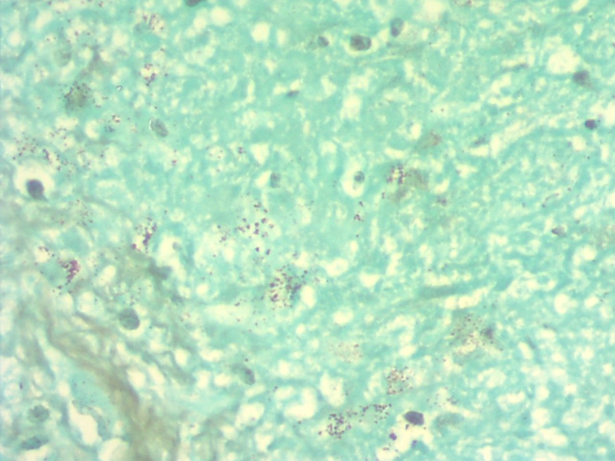 ariella8's tweet photo. #pulmpath #pathbug  49 yo male with lung nodule and cervical lymphadenopathy 
Necrotizing granulomas  but real bug culprit  ?? What do you think? https://t.co/ozVsUKzglR