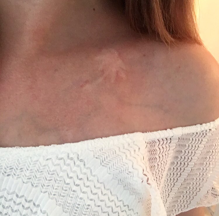 GeorginaArtist's tweet photo. Wearing @LoveIsland tattoos on Scotland’s hottest day was a great idea. #loveisland #tanfail https://t.co/kZDZ81o15l