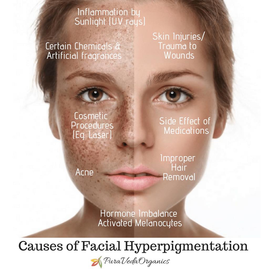 PVOrganics's tweet photo. If you are unfortunate enough to have it, you know that #Hyperpigmentation can be one of the most difficult skin issues to https://t.co/4FiBGQhlai
#OrganicSkincare #acne #agespots #SkinTreatment #DarkSpots #DarkSpotReduction #AntiAging #PigmentedSkin #BioSciencePeptideComplex https://t.co/7mIfAEfszx