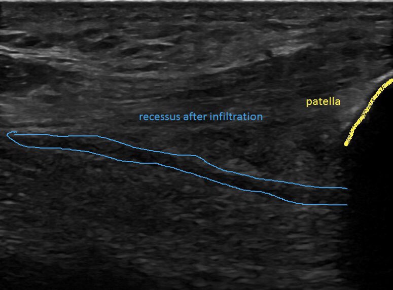SportklinikBern's tweet photo. High precision ultrasound guided injection of a very small recessus suprapatellaris of the knee - under us view it is possible to provide a 100% in target injection- trasversal view during injection #pocus #mskus #kneeinjection #ultrasoundguidedinjection https://t.co/UkFK1i0269