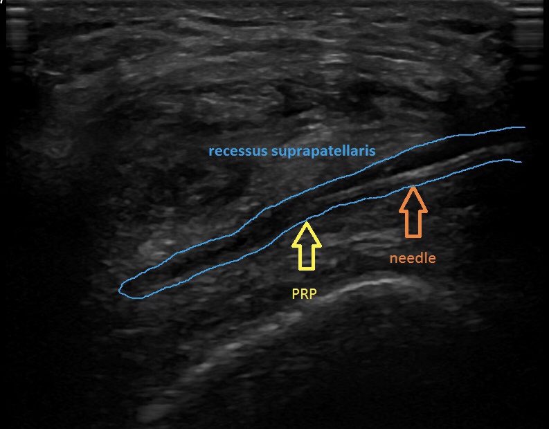 SportklinikBern's tweet photo. High precision ultrasound guided injection of a very small recessus suprapatellaris of the knee - under us view it is possible to provide a 100% in target injection- trasversal view during injection #pocus #mskus #kneeinjection #ultrasoundguidedinjection https://t.co/UkFK1i0269