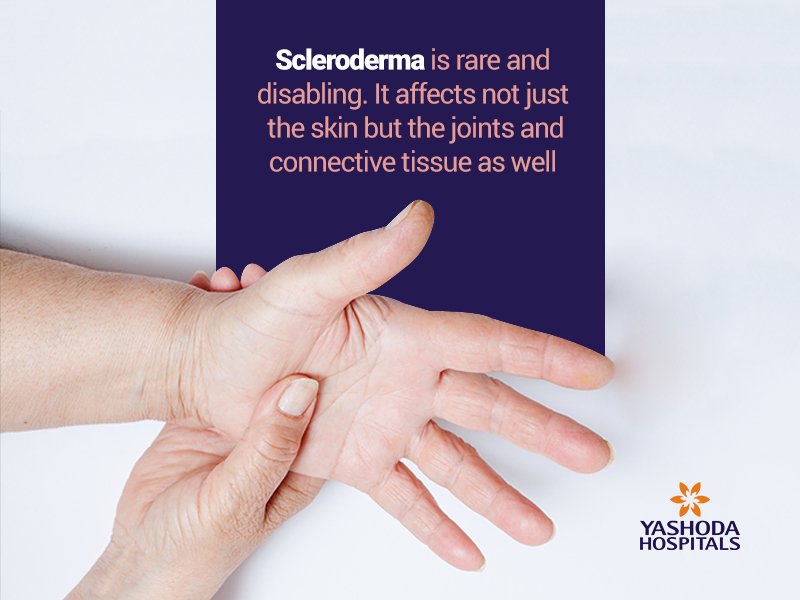 YashodaHospital's tweet photo. #Scleroderma is an #autoimmune condition that affects the connective tissue. Also known as systemic sclerosis, this illness causes hardening of the #skin, #oints and #musclepain, and muscle weakness among other systemic symptoms.
#WednesdayWisdom #health #medicine #healthcare https://t.co/abJ28x7TT7