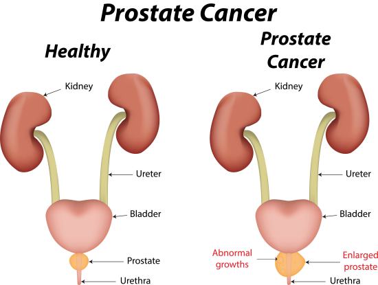 homenaturalcure's tweet image. homenaturalcures.com/prostate-cance…
Prostate cancer - symptoms, causes and other risk factors
#ProstateCancerSymptoms #WhatCauseProstateCancer