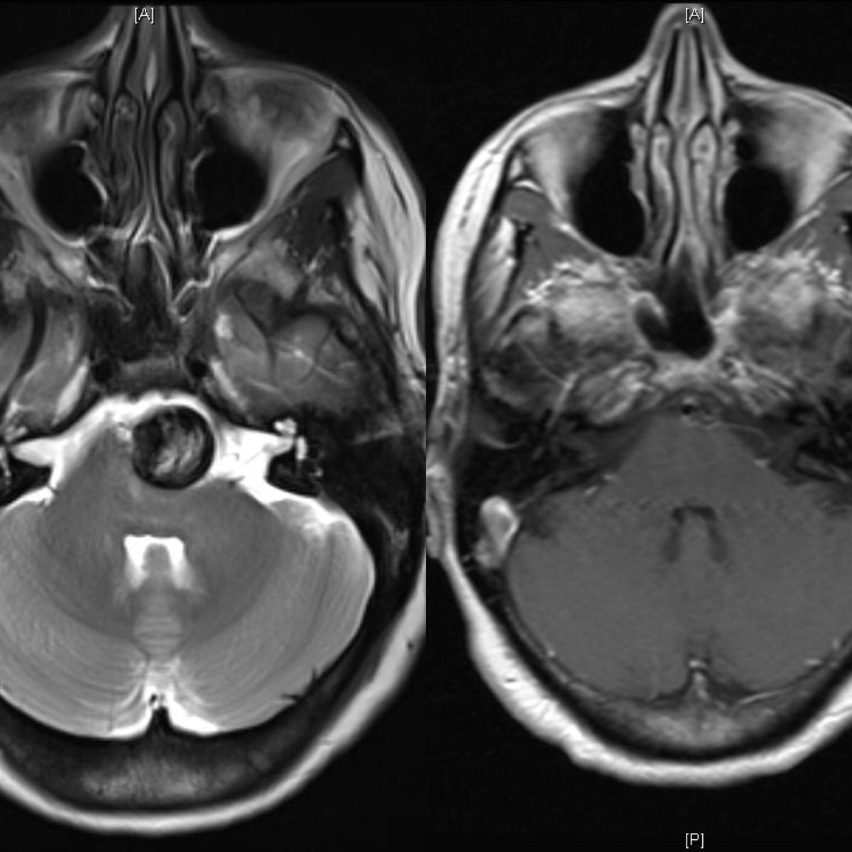 L Fernando Gonzalez (@fegomd) on Twitter photo Can you see it? Now you can’t Pre and post #MRI <a href="/Dukeneurosurg/">Duke Neurosurgery</a> <a href="/cvsection/">CV Section</a> #flow diversion Can you see it? Now you can’t Pre and post #MRI <a href="/Dukeneurosurg/">Duke Neurosurgery</a> <a href="/cvsection/">CV Section</a> #flow diversion