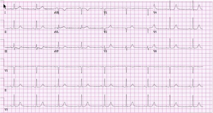 #Spontaneousdissection of the #leftmaincoronaryartery: #Casereport and #briefreview by Manivannan Veerasamy et al. in April/May issue: bit.ly/2Kq54Ka