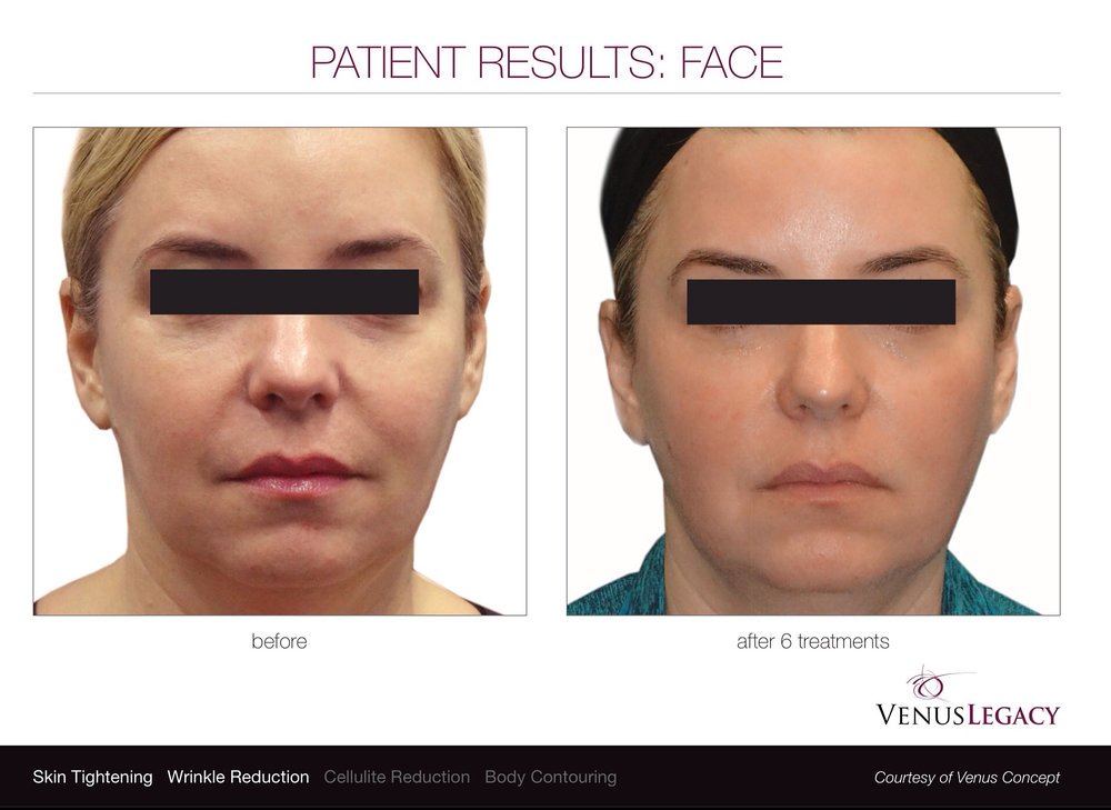 oceancli's tweet image. 7 non-surgical treatments to give your face a lift at Ocean Clinic Marbella: ow.ly/uqwi30kFpiX