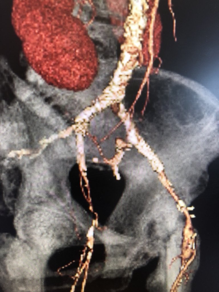 DrAliAzizzadeh's tweet photo. #PAD #restpain #aortoiliac #occlusive disease in a high risk patient treated with axillofemoral bypass #vascularsurgery @CedarsSinai https://t.co/GVBlgg7X5A