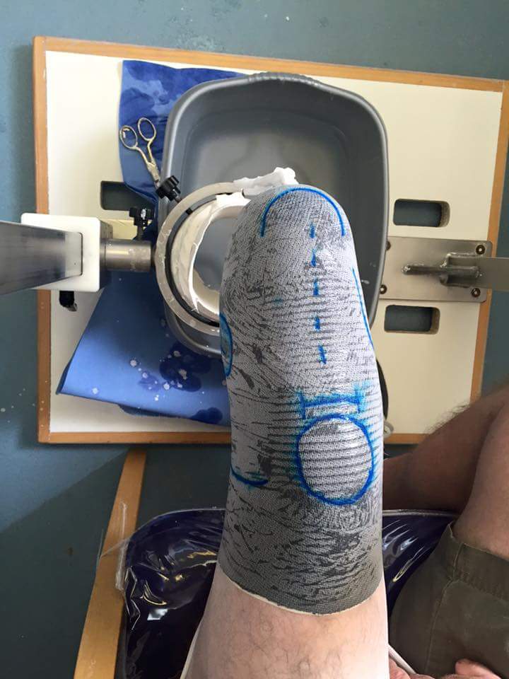 disco2man's tweet photo. Thanks to @mat_dorsetortho @DorsetOrtho for today. #NewSocket #Prosthetics #StriveForBetter https://t.co/erKRUZUdfP