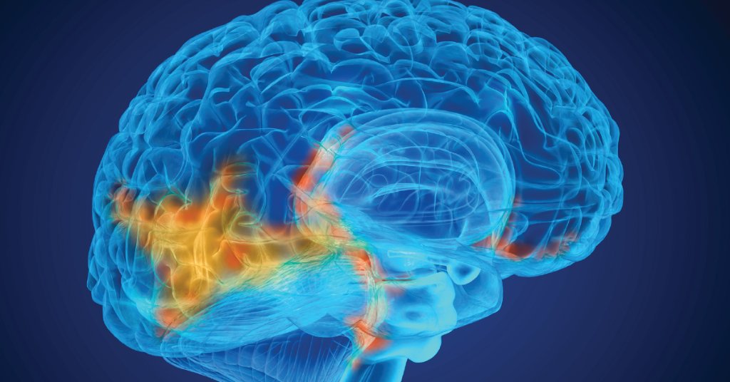 Modified polio vaccine helps fight deadly glioblastoma: ms.spr.ly/6012r4BgK