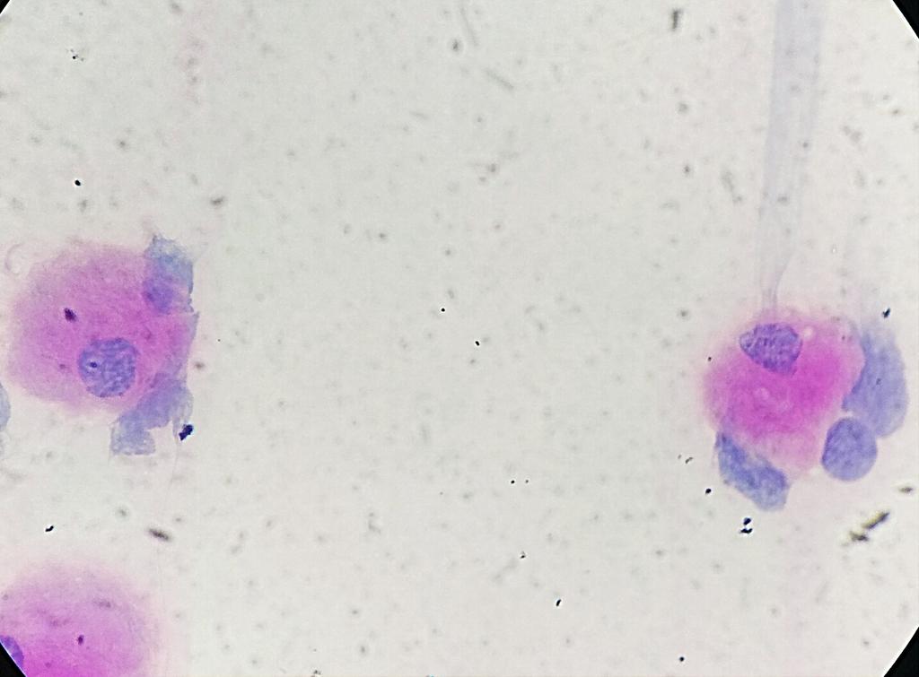Pankaj kumar (@bsc_pankaj) on Twitter photo 6yr boy with hepatosplenomegaly and pancytopenia..! 😁👍<a href="/drsps2k6/">Praveen Sharma</a> <a href="/smlungpathguy/">Sanjay Mukhopadhyay</a> <a href="/UMichPath/">Michigan Pathology</a> <a href="/KDannheimMD/">Kate Dannheim, MD, FCAP (she/her)</a> <a href="/TheKarenPinto/">Karen Pinto DNB, FRCPath</a> 6yr boy with hepatosplenomegaly and pancytopenia..! 😁👍<a href="/drsps2k6/">Praveen Sharma</a> <a href="/smlungpathguy/">Sanjay Mukhopadhyay</a> <a href="/UMichPath/">Michigan Pathology</a> <a href="/KDannheimMD/">Kate Dannheim, MD, FCAP (she/her)</a> <a href="/TheKarenPinto/">Karen Pinto DNB, FRCPath</a>