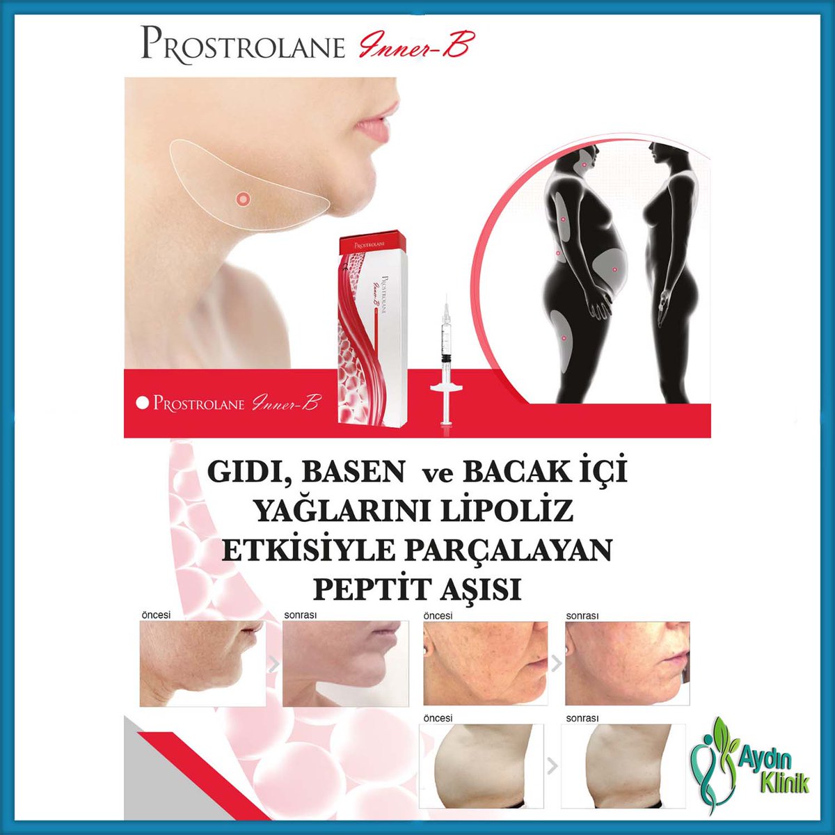 Prostrolane Inner -B ile daha kısa sürede daha sağlıklı yenilenmeniz mümkün. Uygulama hakkında daha detaylı bilgi ve randevu için Whatsapp : 0538 935 70 72 #aydinklinik #dresrayelkenciaydin #prostrolane #prostroleinnerb #lipofiz #peptitaşısı #krışıklık #yüz #estetik #botox
