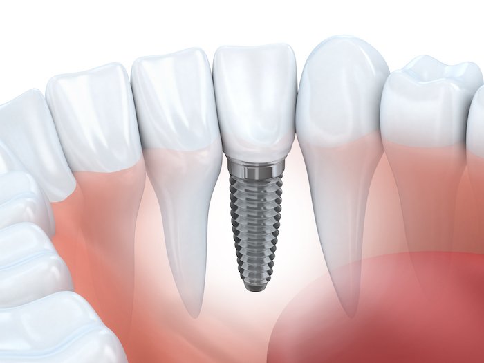 HerndonSmile's tweet image. What Are the Benefits of Dental Implants?
(ow.ly/6mZn30k19fd)

#dentalimplant #toothlossprevention #oralcare