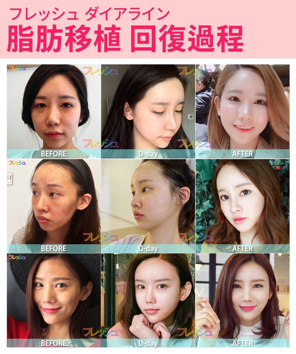 フレッシュ整形外科 Sur Twitter 顔の脂肪移植でますますキレイに フレッシュ整形外科 美容整形 韓国整形 脂肪整形 脂肪吸引 脂肪移植 プチ整形 回復過程 ボリューム 童顔 若返り Eライン 韓国