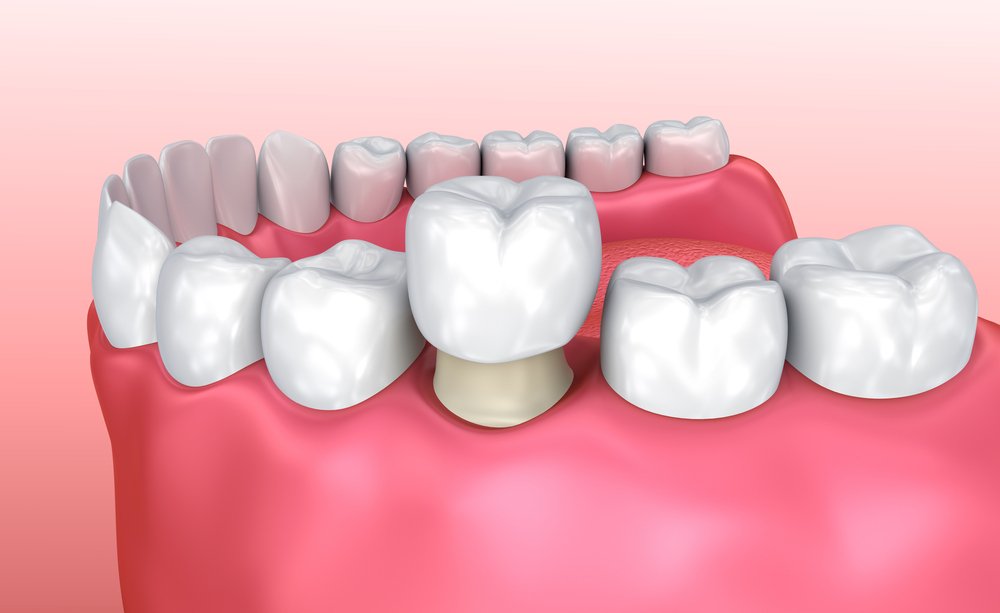HenritzeDental's tweet image. You may have heard the terms #DentalCrown and #DentalCap used a few times. Do you know the difference between the two? Read our blog to learn more. #ToothTrivia buff.ly/2Jo5HXf