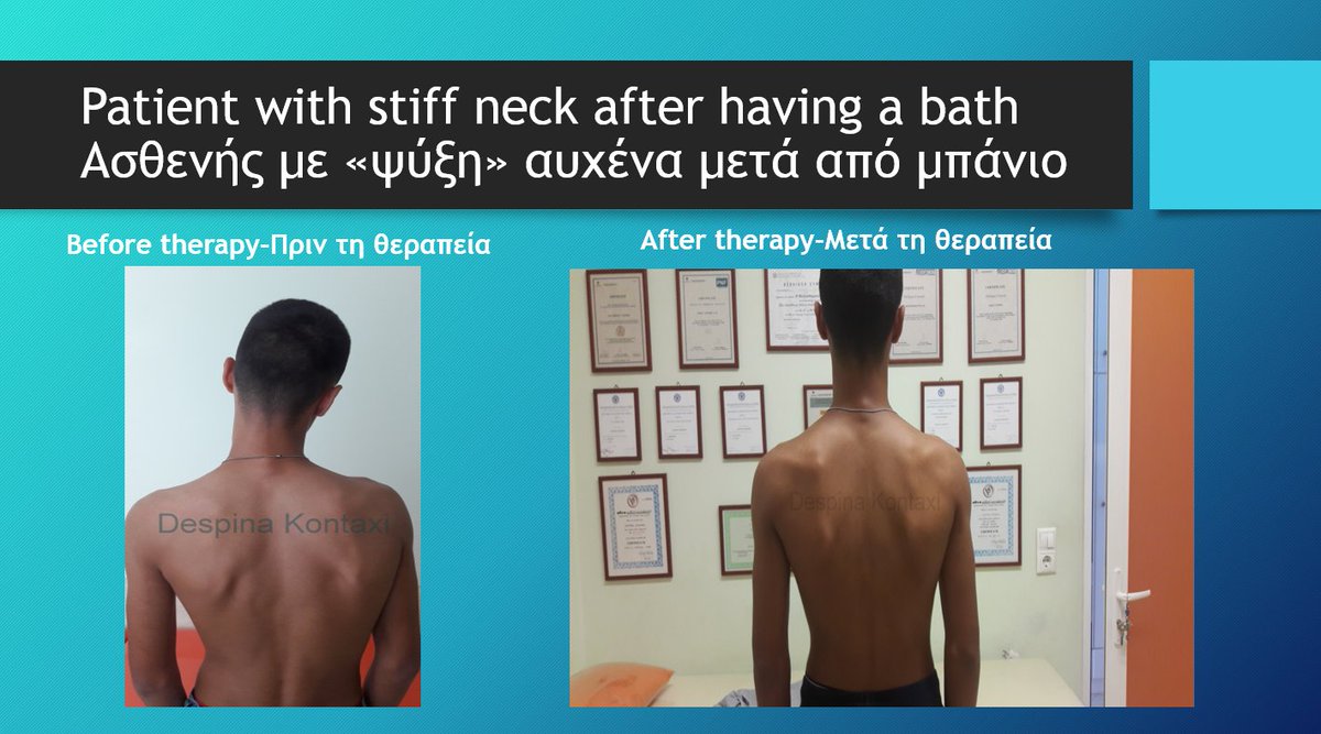 DespinaKontaxi's tweet image. Έκανε μπάνιο και ήρθε έτσι!Είχε ένα άγχος, αν θα ισιώσει η πλάτη του για να χορέψει στο Παλαιόχωρι στο Παγγαιορείτικο αντάμωμα. Σας έρχεται λαμπάδα. #frozen #straightbacks #paggaio #physicaltherapy #physiotherapy #physiotherapist #getyourlife #getyourgoals #enjoysummer