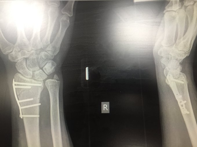 12/7/18. The plate and pins in my wrist.  When i broke it in Two places 6 weeks ago. Still got brake