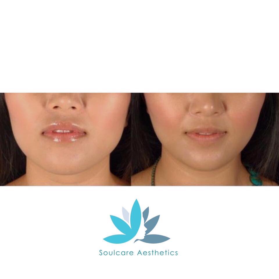 MrIanMorgan's tweet photo. Non-surgical jawline reduction

Achieve a more defined look with a non-surgical fix. A slight tweak can make such a huge difference to a persons face shape and structure!

Contact us for more details: 01543 572838 https://t.co/z6oQMorB26