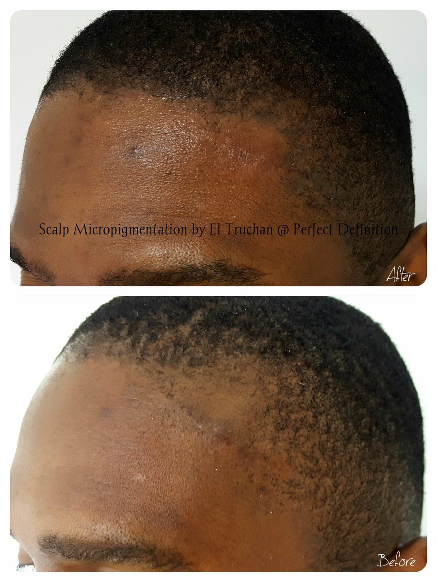 ElTruchan's tweet image. Scalp Micropigmentation by El Truchan @ Perfect Definition

#permanentmakeup #cosmetictattoo #scalppigmentation #micropigmentation #semipermanentmakeup #specialist #beauty #nouveaucontour #hairloss  #definition #london #medicaltattooing #medicaltattoo