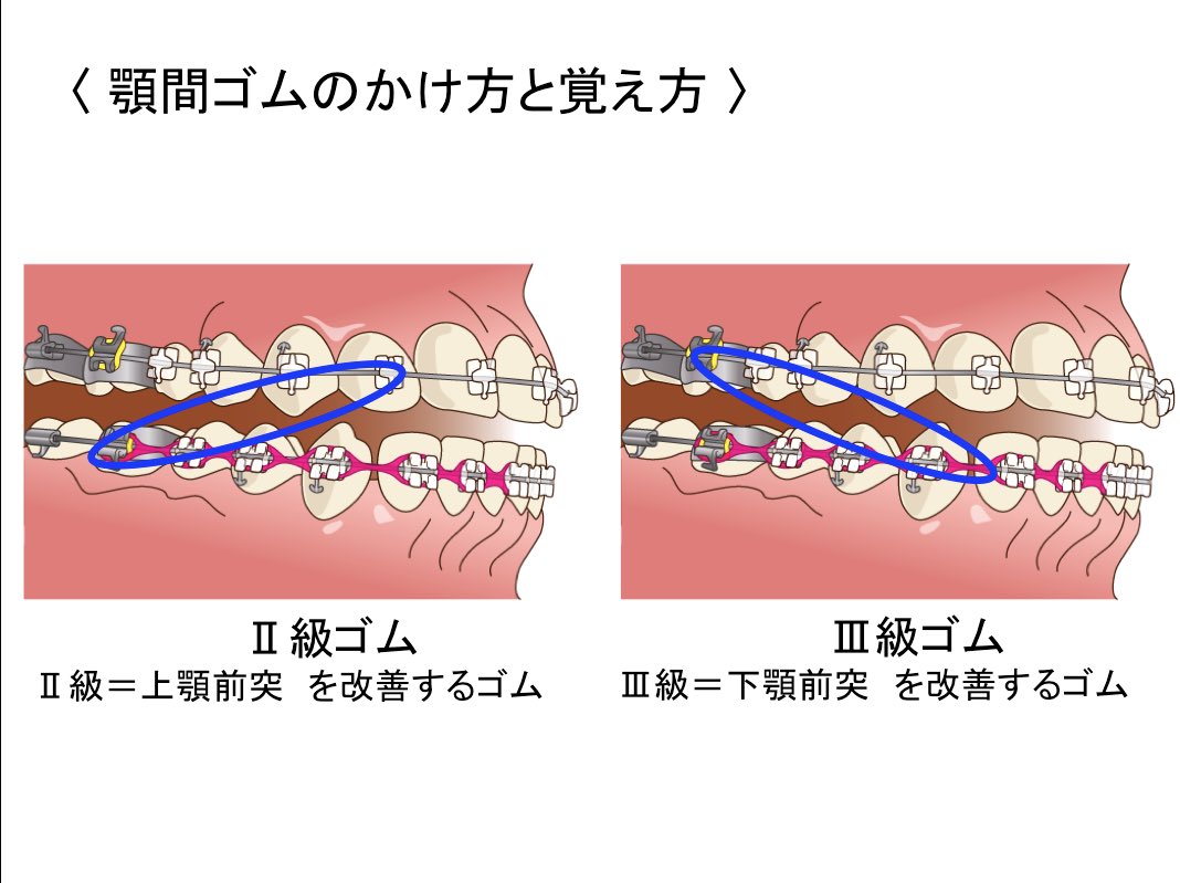 メディスタ【公式】 on X: "〈 顎間ゴムのかけ方と覚え方 〉 矯正で使われる顎間ゴム は、アングルの分類でⅡ級が上顎前突、Ⅲ級が下顎前突と知っていれば、使われるゴムも一緒に覚えれます。 https://t.co/EIYfjxvIbv"  / X