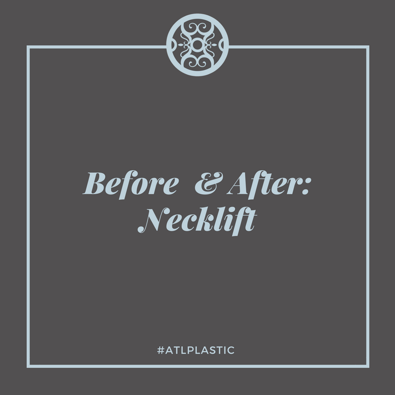 ATLcosmeticsurg's tweet photo. See the results for yourself! This neck lift truly added definition and an attractive contour to our patient's facial profile. Swipe to see the transformation! ✨ #ATLPlastic https://t.co/AK8uih4Qjx