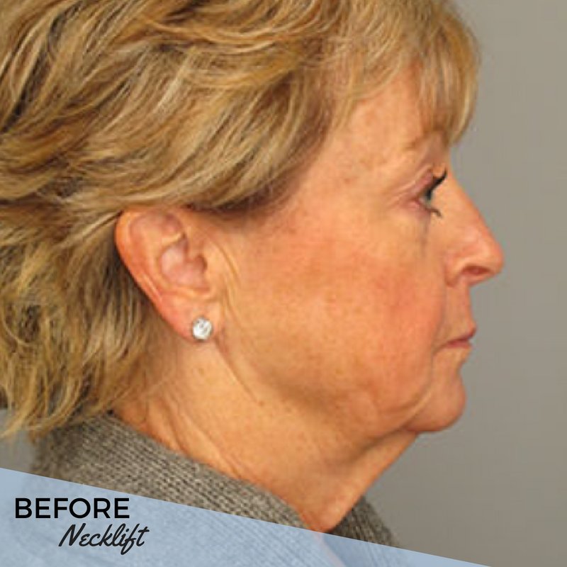 ATLcosmeticsurg's tweet photo. See the results for yourself! This neck lift truly added definition and an attractive contour to our patient's facial profile. Swipe to see the transformation! ✨ #ATLPlastic https://t.co/AK8uih4Qjx