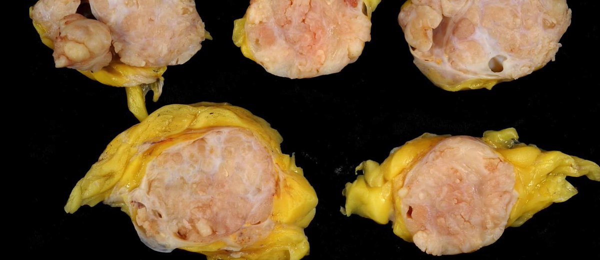 nutrition_facts's tweet photo. DNA-damaging chemicals, formed when meat is cooked, stimulate breast cancer cells almost as much as pure estrogen, and can infiltrate the ducts where most breast cancers arise. https://t.co/45PrLV3o43 https://t.co/IgcvaP8MIu