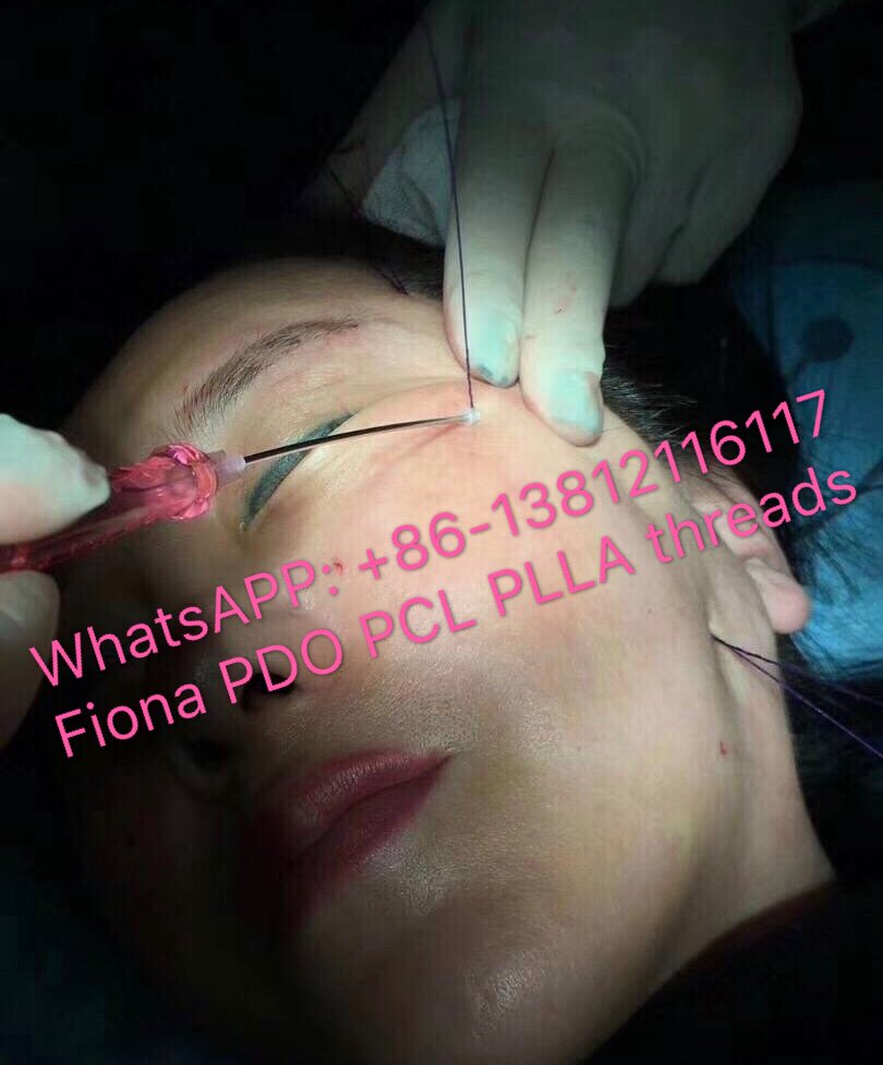 Fiona_thread's tweet image. Cog lift threads with USP 2 barbed threads, the most strong and efficiency lifting threads with 28G cannula! #cogthreads# #barbedthreads# #liftingthreads# #facelift# #threadslift# #sugaethreadlift# #pdohilo# #pcllift#