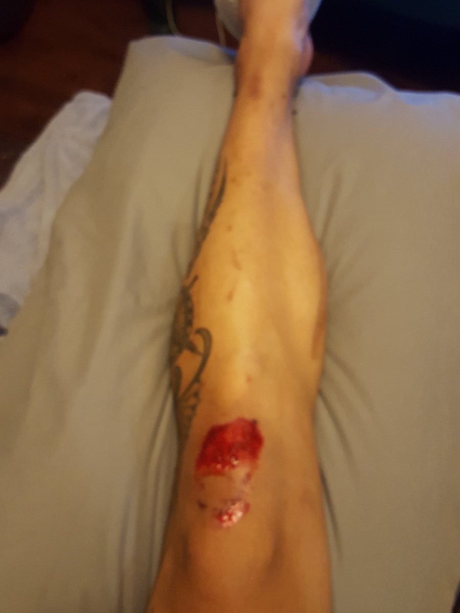 KKPaulOCR's tweet photo. Of course this happens before my next 2 days off. Cycling like a mad dog down the trails. F@%K!!! https://t.co/9GPOlIWmND