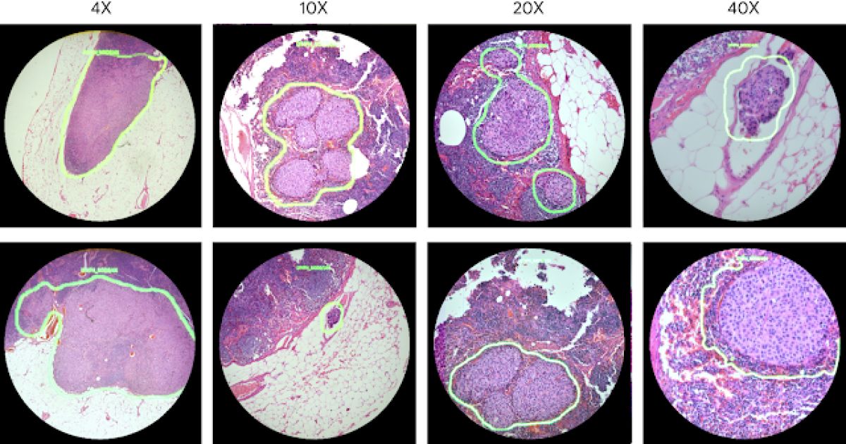 eva_m_fors's tweet image. A brilliant article to read, explaining how Google researchers are aiding Cancer research using AI technology and augmented reality. A massive success. engt.co/2KwNTGT