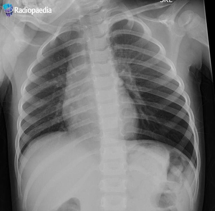 Radiopaedia's tweet photo. #UKRCO2018 Case Contest - our first case is a paediatric presentation. 18 month old boy playing in the garden and suddenly breathless. Can you tell us why? Answers to https://t.co/gew9TrhgWB #casecontest https://t.co/UWycqjiI8j