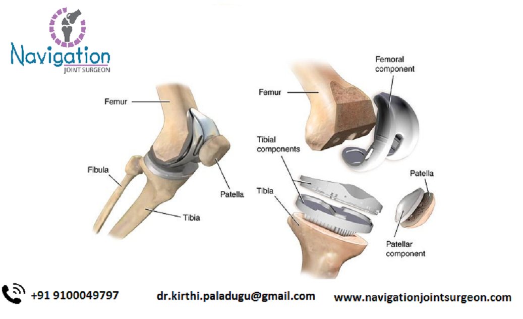 KirthiPaladugu's tweet photo. In a recent medical research, it clearly indicated that robot-assisted #joint_replacement #arthroplasty to be precise, was more effective when #surgeons use #robotic_arm_technology #Knee_Arthroscopy_Hyderabad #hip_replacement #Shoulder_replacement
https://t.co/MItHUreDQ0 https://t.co/fH5FXxYzmg
