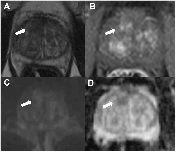 EurUrolFocus's tweet photo. Prostate Indeterminate Lesions on Magnetic Resonance Imaging—Biopsy Versus Surveillance: A Literature Review https://t.co/3m8Gh0v9It https://t.co/IEejL8Rons