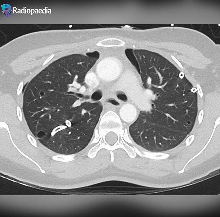 Radiopaedia's tweet photo. Chest Case for #UKRCO2018 - fit and well young female, suddenly breathless. What’s happened and what’s the underlying diagnosis? Submit your answers at https://t.co/gew9TrhgWB #chest #thoracicradiology #radiology #supportradiopaedia #casecontest #FOAMrad #FOAMed https://t.co/UC8CFHCUqQ