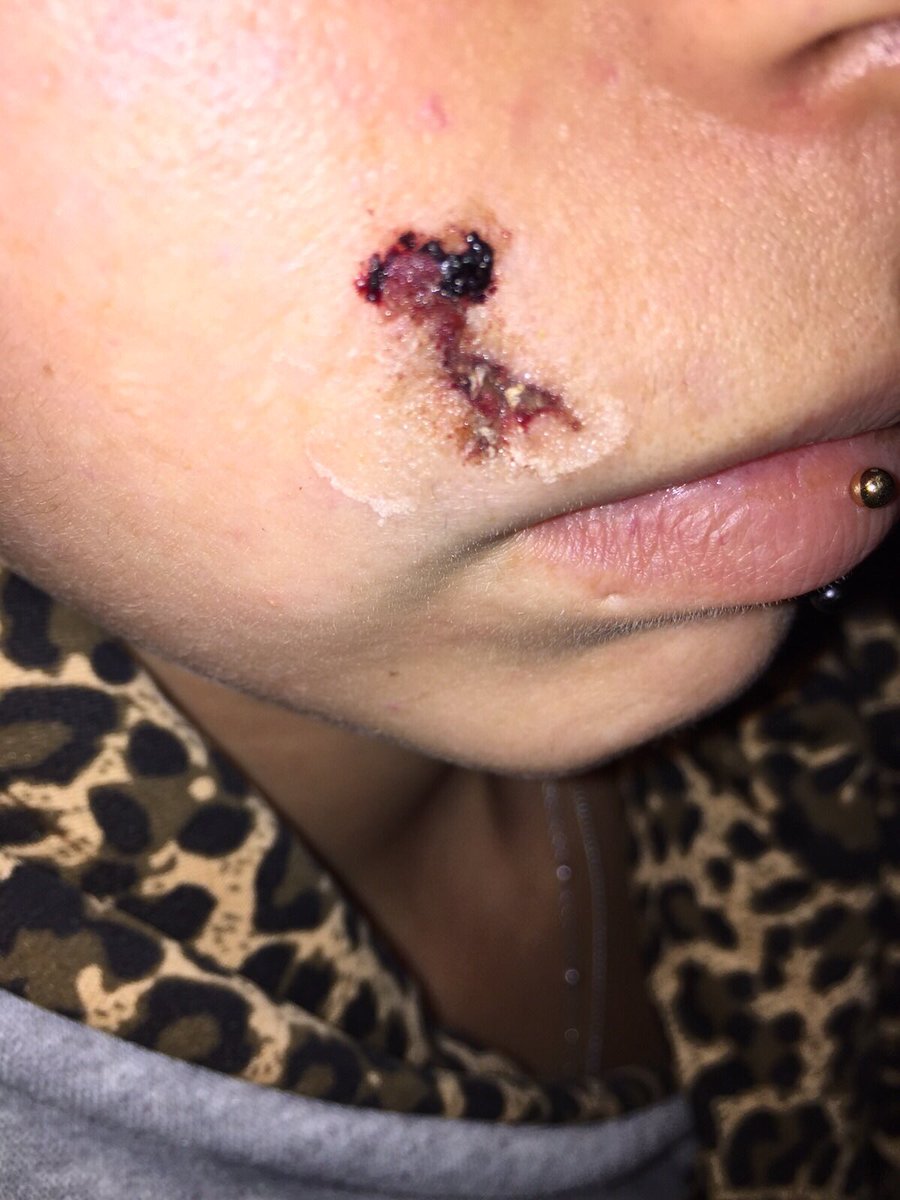 jeroenwetzels's tweet photo. Nadat een ontsnapte TBS'er een mes in haar gezicht stak, moest Shanti met een advocaat het onderzoeksrapport van het incident boven tafel krijgen. Na 2,5 jaar is het gelukt. #TBS #Purmerend #Inforsa
https://t.co/TAkLe63qAt https://t.co/fu1PFQ5zHX