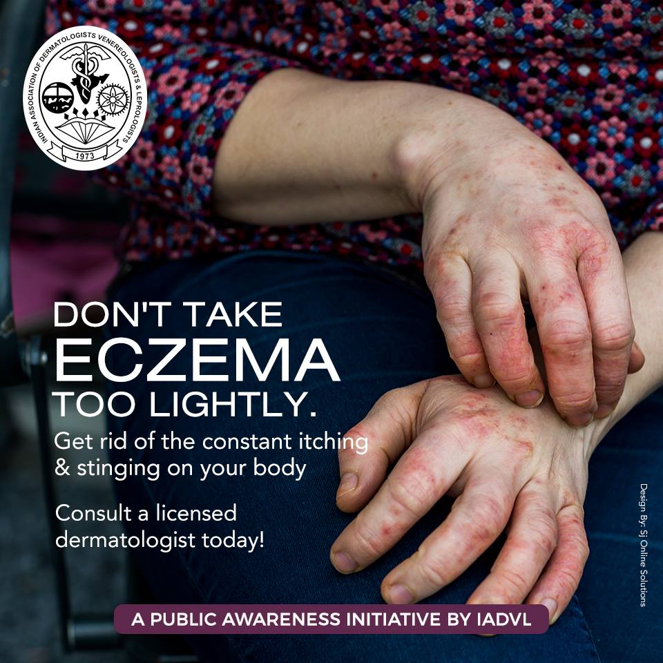 Don't take Eczema too lightly. Get rid of the constant itching &amp; stinging on your body. Consult a licensed dermatologist today!

#IADVL #Eczema #Itching #IADVLSkin