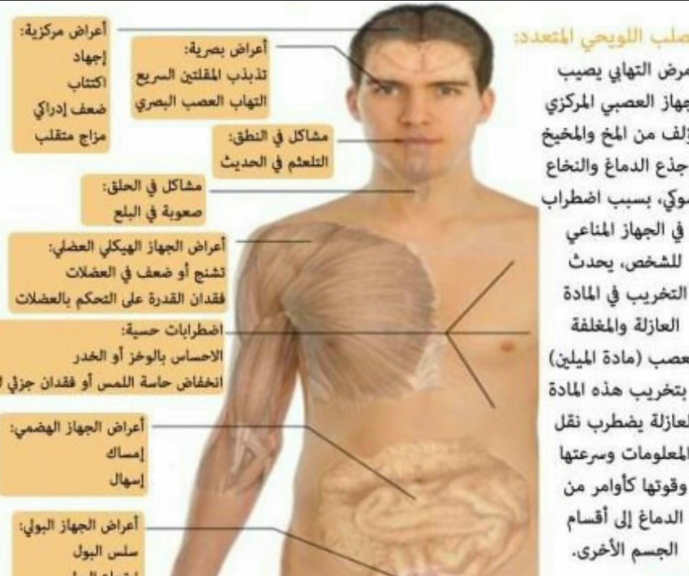 اللويحي اسباب التصلب التصلب المتعدد