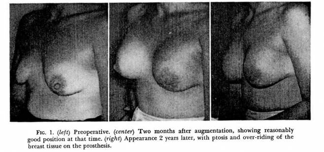 oceancli's tweet image. Did you know, #breastimplants have been around more than 55 years? Read their history on our blog: ow.ly/87XB30kMacP