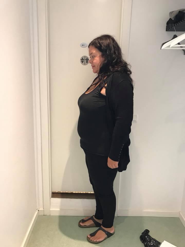 ngballoon's tweet photo. She lost 41 kg of her weight in 1 year with #Spatz gastric balloon, had only 500 ml, no up-adjustments. Her initial weight was 112 kg. Lisette is 37-year-old #Danish lady. #obesity @asmbs @MPGN46 @DrTSaleh @DrAlahdab #Denmark https://t.co/QIYXLxvuBp