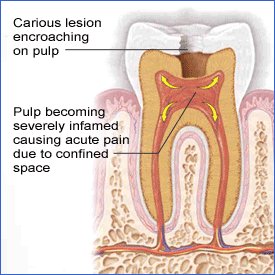 dentalres1's tweet image. #Pulpitis is is inflammation of dental pulp tissue.