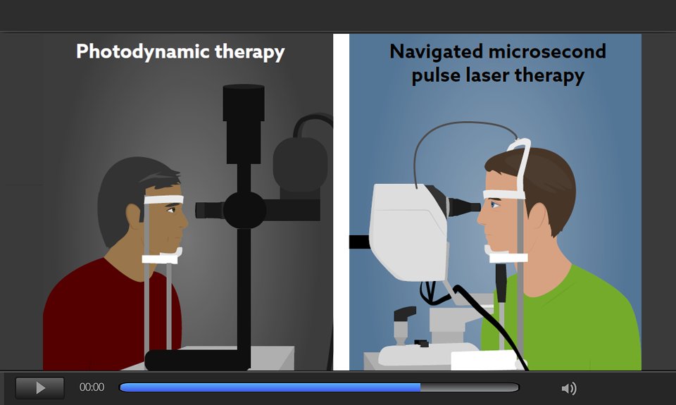 OD_OS_Navilas's tweet image. Comparison of #PDT and navigated #microsecond laser for #CSCR - watch publication video: od-os.com/navilas-expert… #navilas