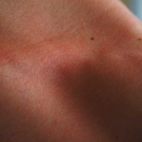 berman_skin's tweet photo. We all know wearing protective clothing and sunscreen helps prevent a sunburn, but what do you do if you get a sunburn? A study published in the Journal of Investigative Dermatology suggests high doses of Vitamin D might also help. 

<https://t.co/ycijGzIwJ7>. https://t.co/DvJhJrqqPQ