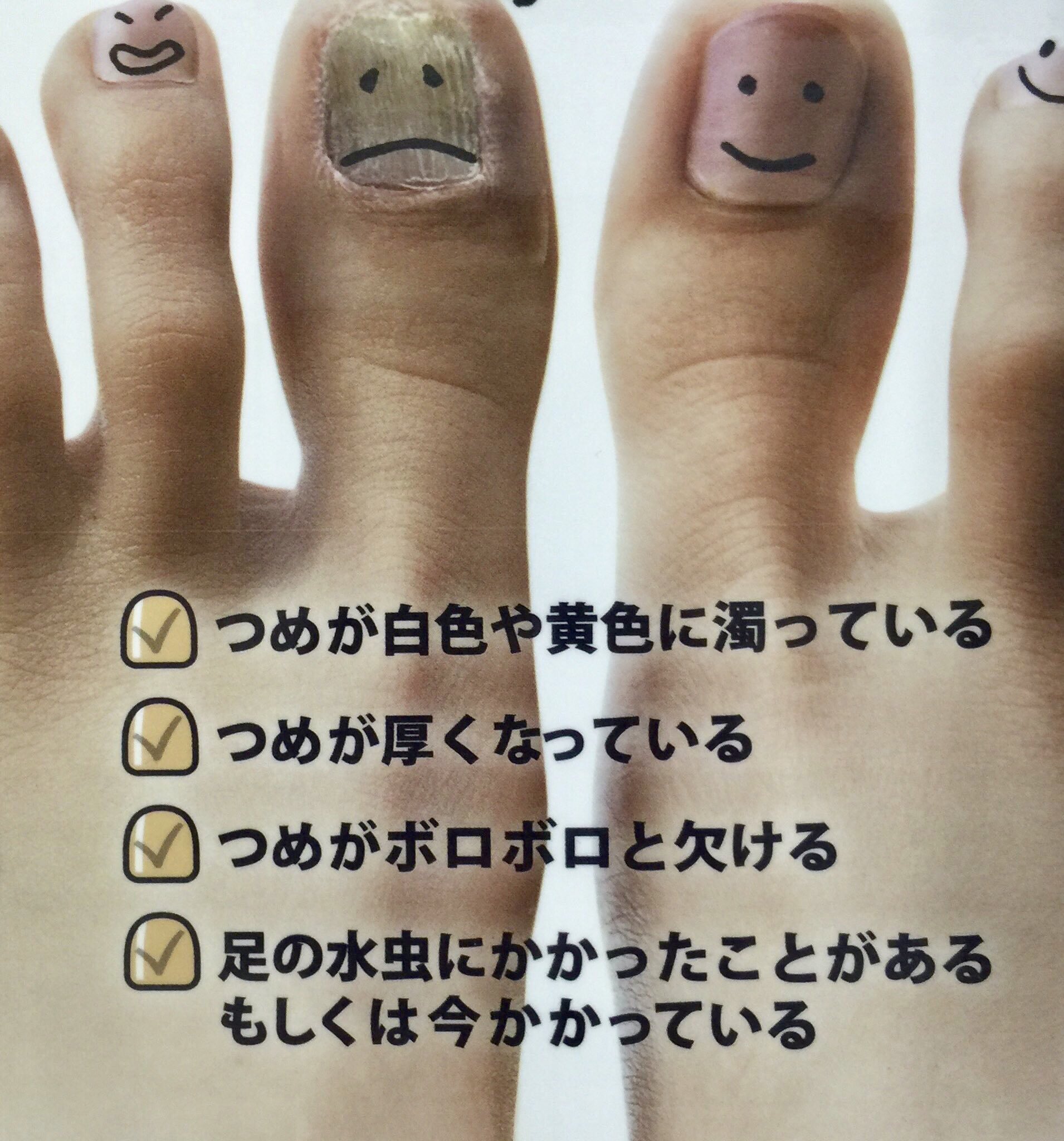 オノダクリニック Onoda Clinic 梅雨の時期から夏にかけては白癬 水虫 が発症しやすくなります 白癬菌は湿度が70 以上になると活性化して増殖していきます 特に爪白癬については完治まで1年以上かかる場合もありますので 根気強い治療が必要です 早めに