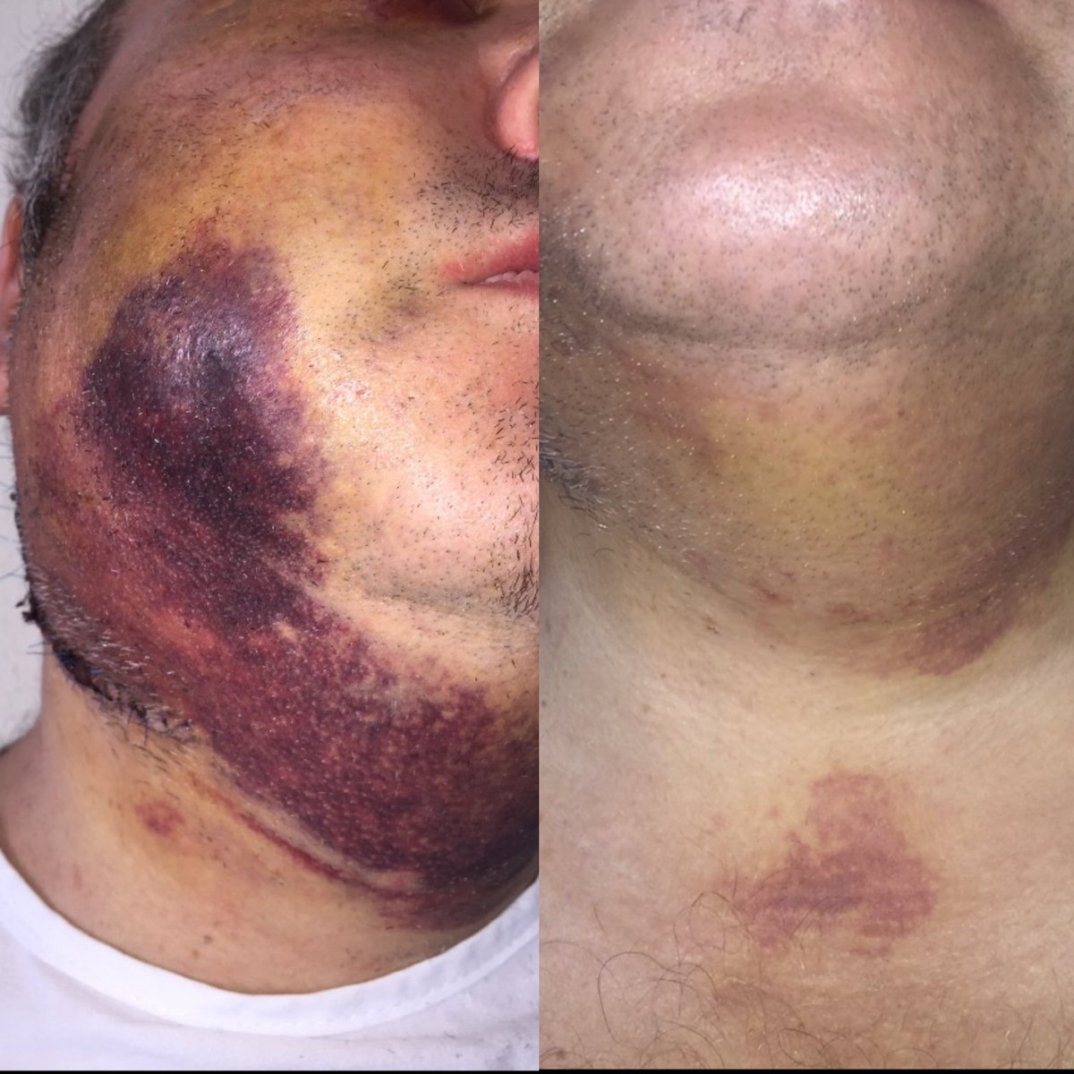 EllipseSpain's tweet photo. ♡ Resultado de ·hematomas post-operatorios antes y 5 días después con #NordlysbyEllipse ♡ 》El estudio realizado por el Dr. P. Boixeda y el Dr. A. Sánchez Alegre concluye que....➡️+ info en https://t.co/1nRHPn4qsj 

#ellipseresults #SelectiveWavebandTechnology #pulsocorto https://t.co/fYMEyvvwSx