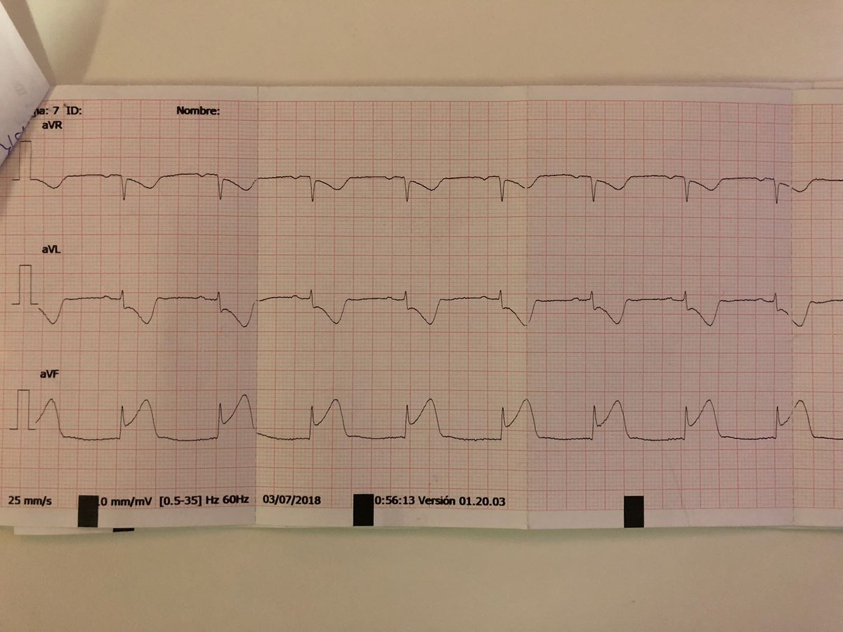 carprimur's tweet photo. El reto para hoy es identificar la arteria responsable de un IAMCEST a través del ECG. (Caso enviado por @juangdelara) 
Muy recomendable leer - > https://t.co/b9xcyfy6eQ https://t.co/NzEEzoUaBX