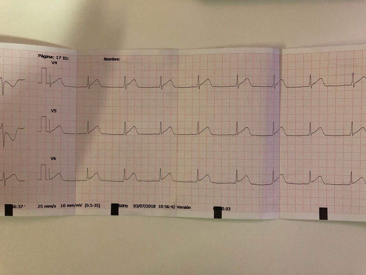 carprimur's tweet photo. El reto para hoy es identificar la arteria responsable de un IAMCEST a través del ECG. (Caso enviado por @juangdelara) 
Muy recomendable leer - > https://t.co/b9xcyfy6eQ https://t.co/NzEEzoUaBX