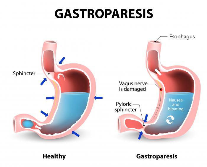 diabeticswithed's tweet image. DWED members &amp;amp; HCP members: your latest content package is available! We offer 5 case studies on #gastroparesis + a general factsheet. You can also listen to our podcast interview on #AutoimmunePolyglandularSyndrome with the brilliant @RNeilABlack. #T1ED #T1Diabetes #diabulimia