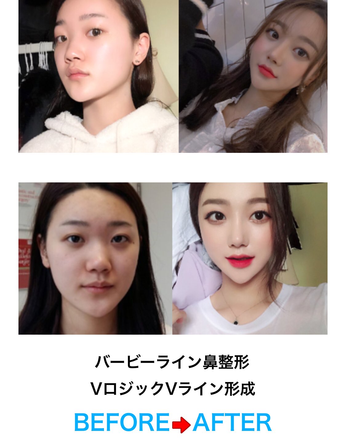 韓国美容観光エージェンシーharu 平たい顔が悩みだった女性が 鼻整形とvライン手術を受けて 韓国 アイドル級の美女に 大変身されました っっっ 韓国整形 より詳しい情報が気になる方は Blogをチェックし 韓国美容観光エージェンシーharu 平たい顔が悩みだった女性が 鼻整形とvライン手術を受けて 韓国 アイドル級の美女に 大変身されました っっっ 韓国整形 より詳しい情報が気になる方は Blogをチェックし