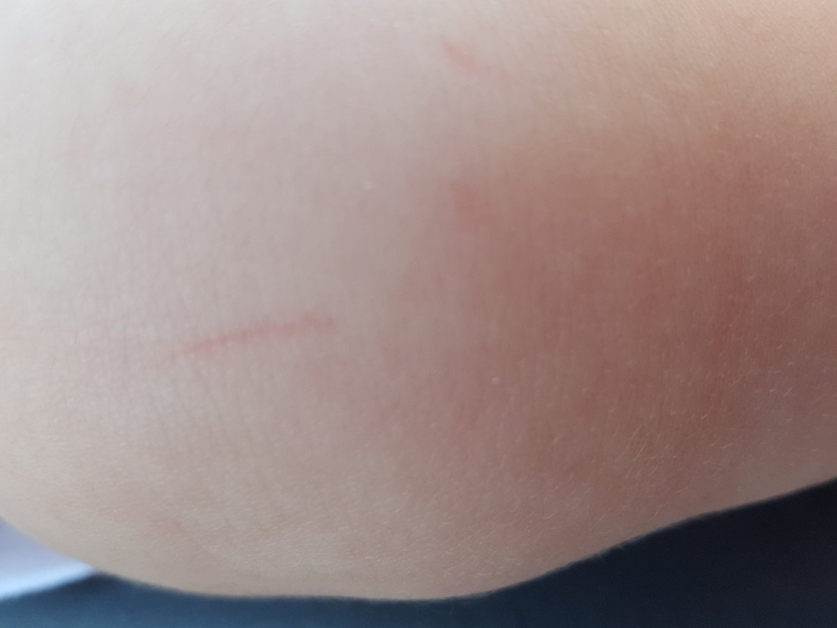 lisecostello's tweet photo. @AldiUK Sharp edges on baby trolley cut my baby girls leg. When finally found staff member was not offered a replacement trolley (as only had 1 coin) or even something to cover the sharp bit.  Staff not bothered at all. This was Aldi Rawtenstall. https://t.co/Wwf0z4Bn9a