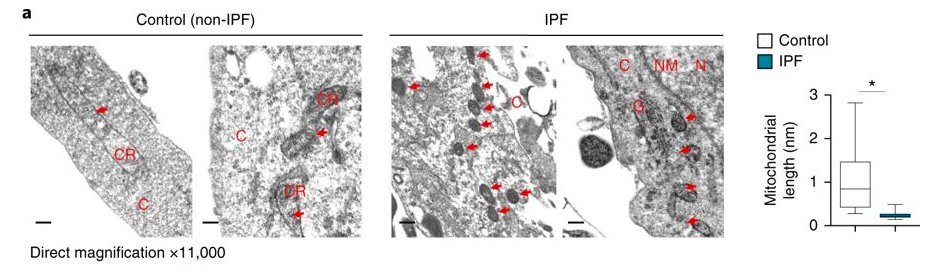 Metformin reverses established lung #fibrosis in a bleomycin model in mice: go.nature.com/2Npx9Di